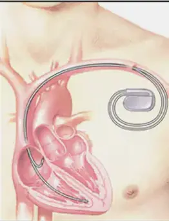 細數(shù)心臟起搏器和ICD之間的差異 細數(shù)心臟起搏器和ICD之間的差異